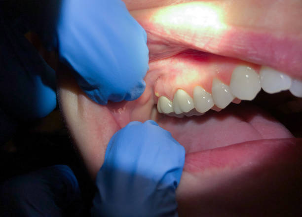 Best Emergency Tooth Extraction in Coopersburg, PA